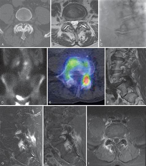 pars sclerosis tomographic finding